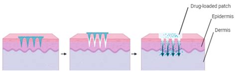 Recent Advances in Microneedle Platforms for Transdermal Drug Delivery ...