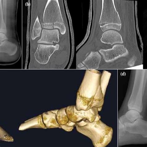 A 12-year-old boy with a 3-part triplane fracture of the left ankle ...