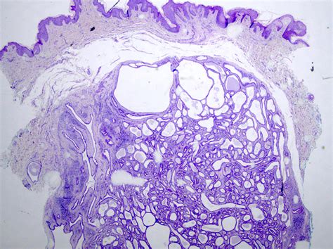 Tubular Apocrine Adenoma Icd 10