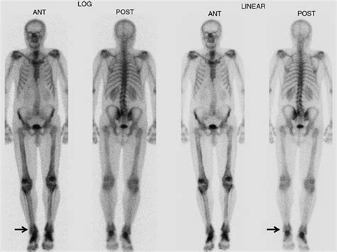 Image result for Radionuclide Scan