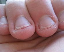 Image result for Scratch Nail Dent