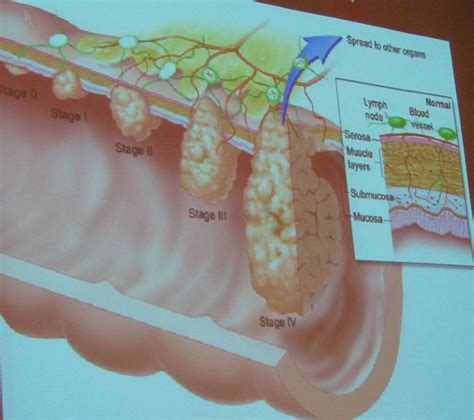 Image result for Colon Cancer Poop