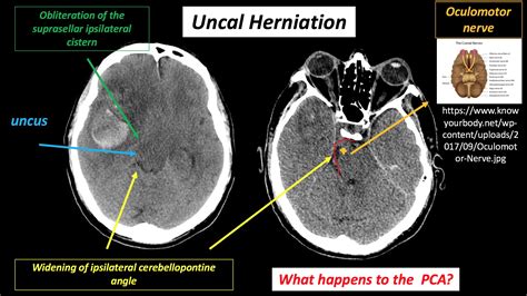 Uncal Herniation Cranial Nerve 3