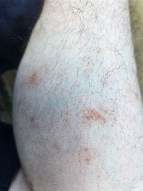 35M with bursted blood vessels in calves and feet : r/AskDocs