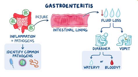 Infectious gastroenteritis: Clinical sciences - Osmosis Video Library