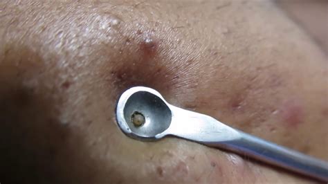 Image result for Solar Comedones Extraction