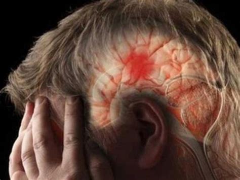 Brain Stroke symptoms: ब्रेन स्ट्रोक के 6 शुरूआती संकेत और लक्षण जो ...