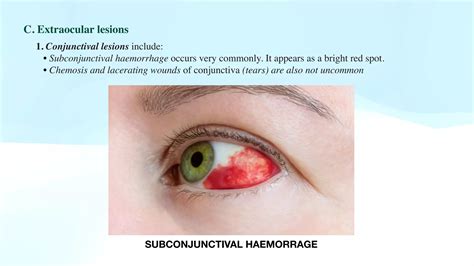 OCULAR INJURIES | PDF