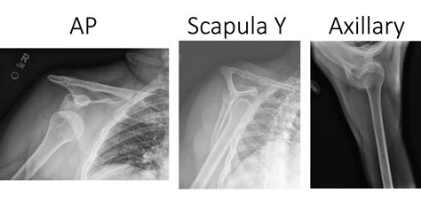 Shoulder X-Ray Series at Kenneth Locke blog