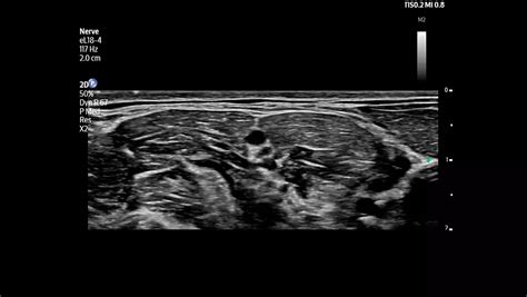 Philips-Flash-Ultrasound-System-5100-Point-of-Care