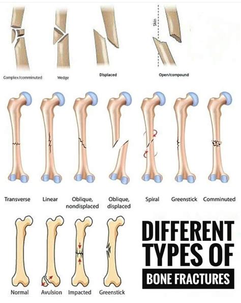 Open vs. closed fracture - sushikool
