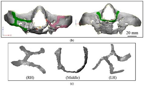 Investigation of Patient-Specific Maxillofacial Implant Prototype ...