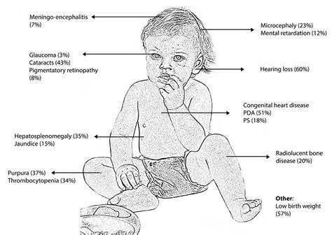 Congenital rubella causes, symptoms, diagnosis & treatment