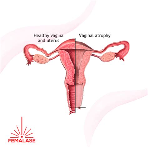 WHY IS MY VAGINA SUDDENLY DRY? - Femalase