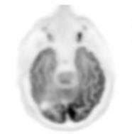 Artificial intelligence guides lower PET radiation dose | Center for ...
