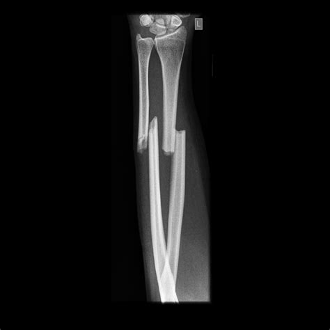 Radius Ulna Fracture X Ray at Nancy Green blog