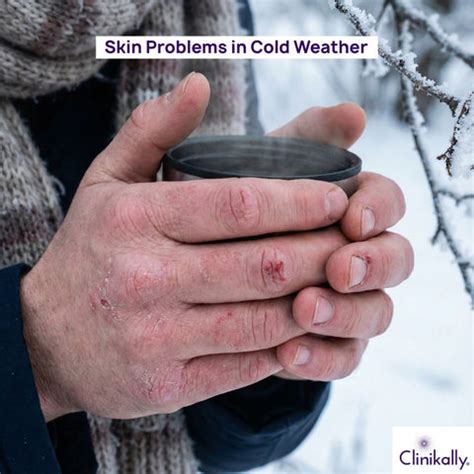 Skincare Routine for Winter: Expert Tips for Healthy Skin