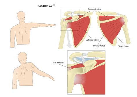 Rotator Cuff Shoulder Pain Diagnosis Chart | Portal.posgradount.edu.pe