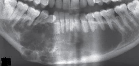 Academy of Dental Knowledge: Ameloblastoma