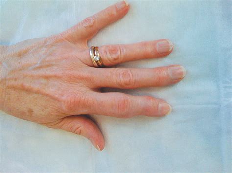 Psoriatic Arthritis