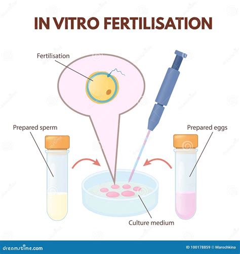 Stages Of In Vitro Fertilization Medical Banner Vector Illustration | CartoonDealer.com #145358656