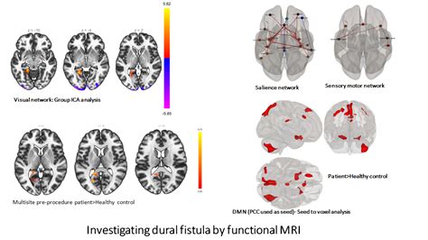 Fistula Disease Portal- Sree Chitra Tirunal Institute for Medical ...