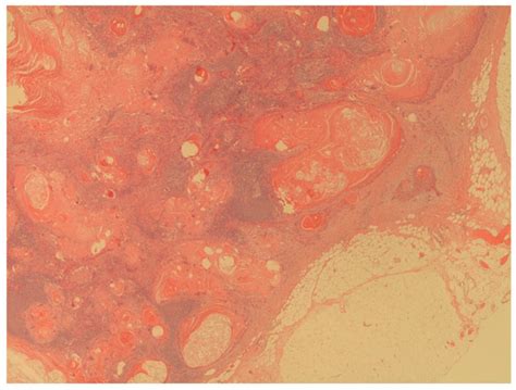 Prophylactic Lymphadenectomy in Patients with Penile Cancer: Is Sooner ...