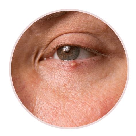 How To Remove A Piercing Bump At Home - Dibujos Cute Para Imprimir