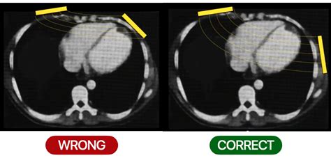 Image result for Synchronized Cardioversion Pad Placement