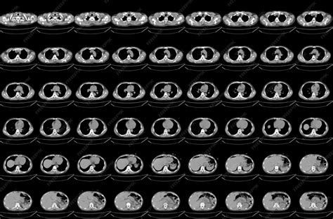Premium Photo | Ct scan abdomen of the patient's diffuse bronchial wall thickening and mild ...