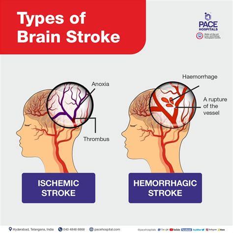 Brain Stroke: Types, Causes, Symptoms, Prevention and Treatment