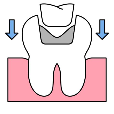 Image result for Tooth Mobility Classification Chart