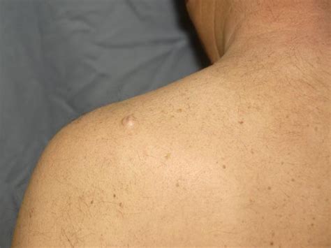 Image result for Explosive Back Cysts