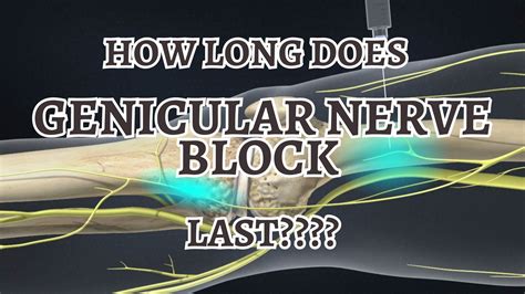 How Long Does Genicular Nerve Block Last? TIPSS