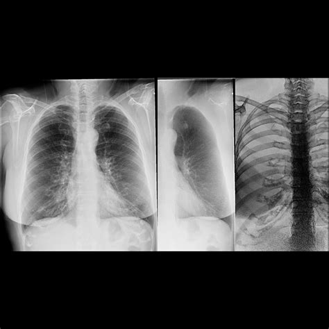 Dual Energy Subtraction | GE Healthcare (India)