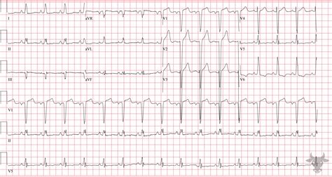 Left Ventricular Hypertrophy | ECG Stampede