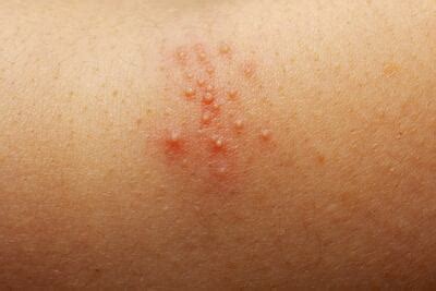 Q&A: What causes heat rash? | Expert Opinion