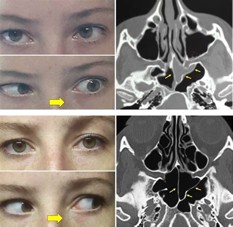 Isolated abducens palsy due to acute sphenoid sinusitis - International ...