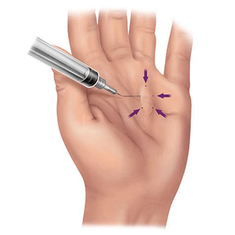 Bildergebnis für dupuytren's surgery pictures