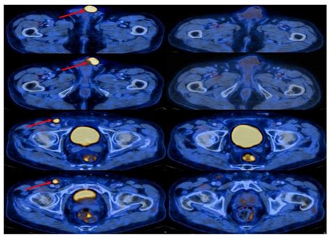 Cemiplimab as First Line Therapy in Advanced Penile Squamous Cell ...