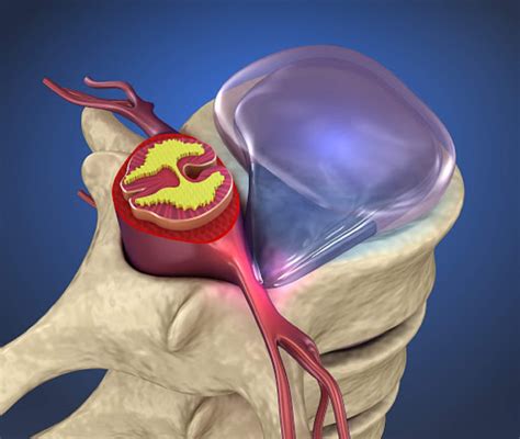 Lumbar Herniated Disc Epidural Injections at Wilfred Tipton blog