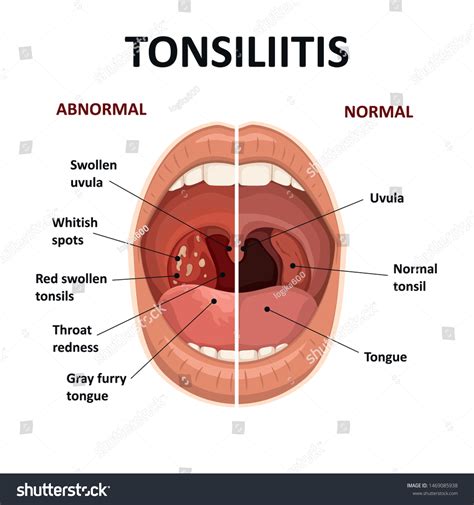 Tonsil Stones Diagram