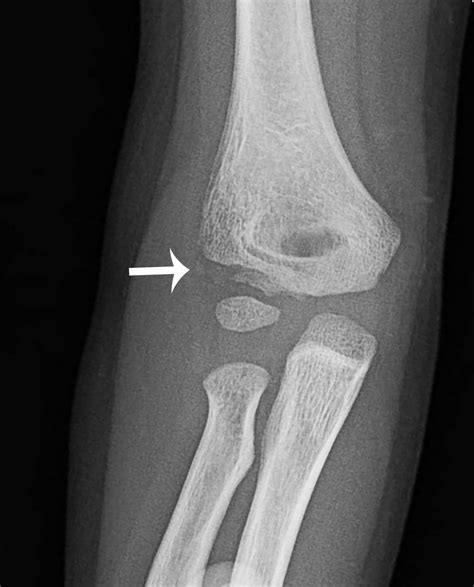 Medial Epicondyle Fracture X Ray at Johnny Whitney blog