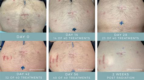 Radiation for Prostate Cancer Before + After Photos