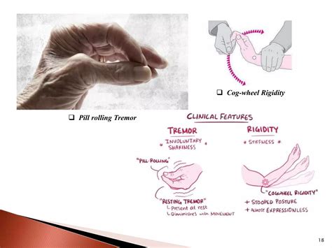 PARKINSON’S DISEASE.pptx