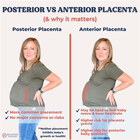 Bebe Posterior Vs Anterior Anterior Vs Posterior Placenta: Difference