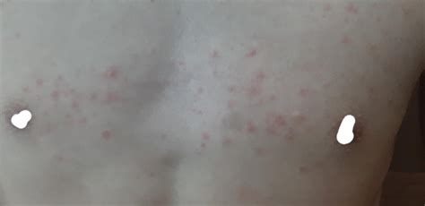 Mụt màu đỏ nổi ở ngực / Red pimples on chest : r/VietNam