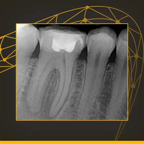 O Que é Radiografia Periapical - RETOEDU