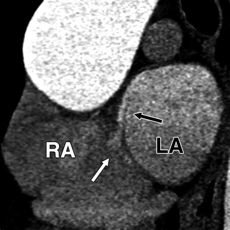 ECG-Gated Cardiac CT Angiography Using 64-MDCT for Detection of Patent ...