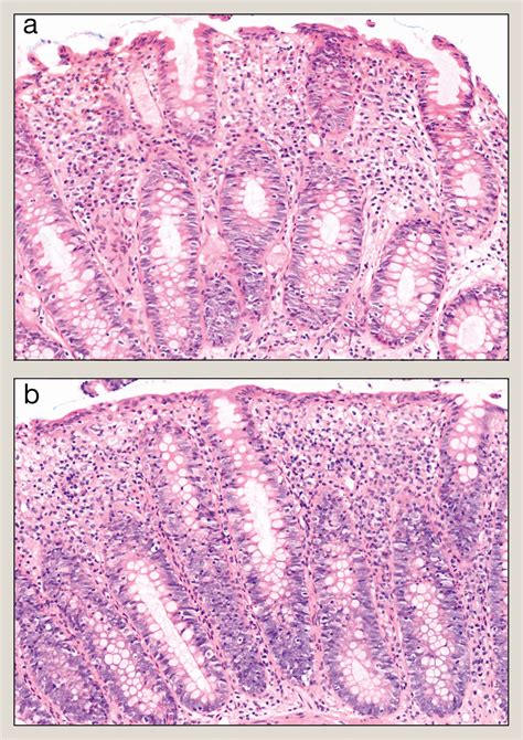Microscopic colitis: what's in a name? An overview from clinical and ...